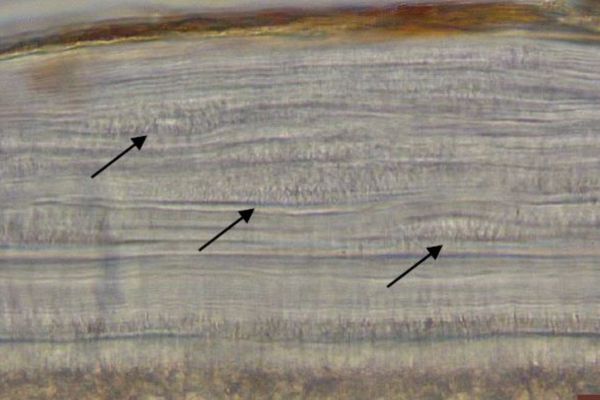 Caption: Variations in a tooth's cementum rings caused by smoking damage